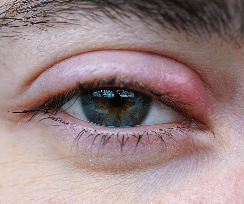 Understanding Styes: Causes, Symptoms, and Treatment Options at Benjamin Eye Institute
