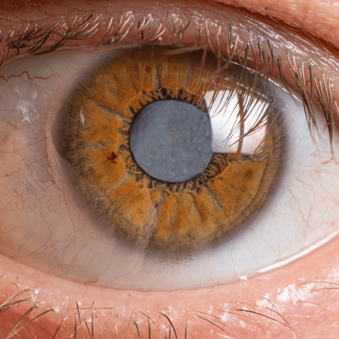 Understanding and Treating Posterior Capsular Opacification after Cataract Extraction