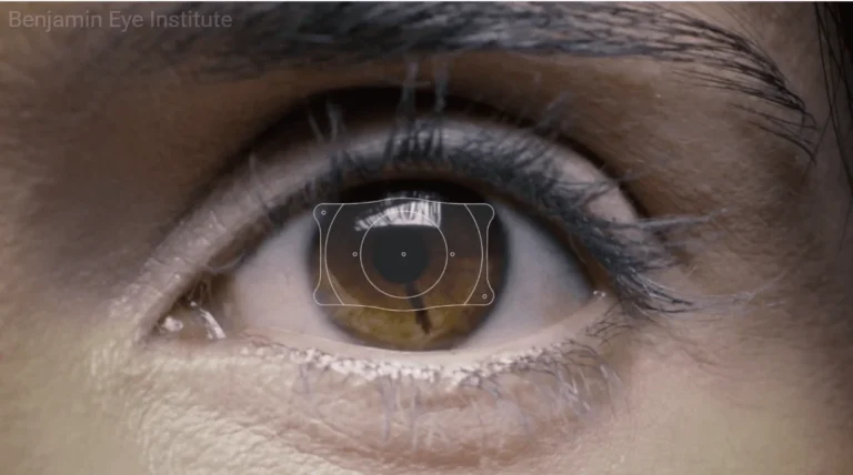 Beyond LASIK: The EVO ICL Difference