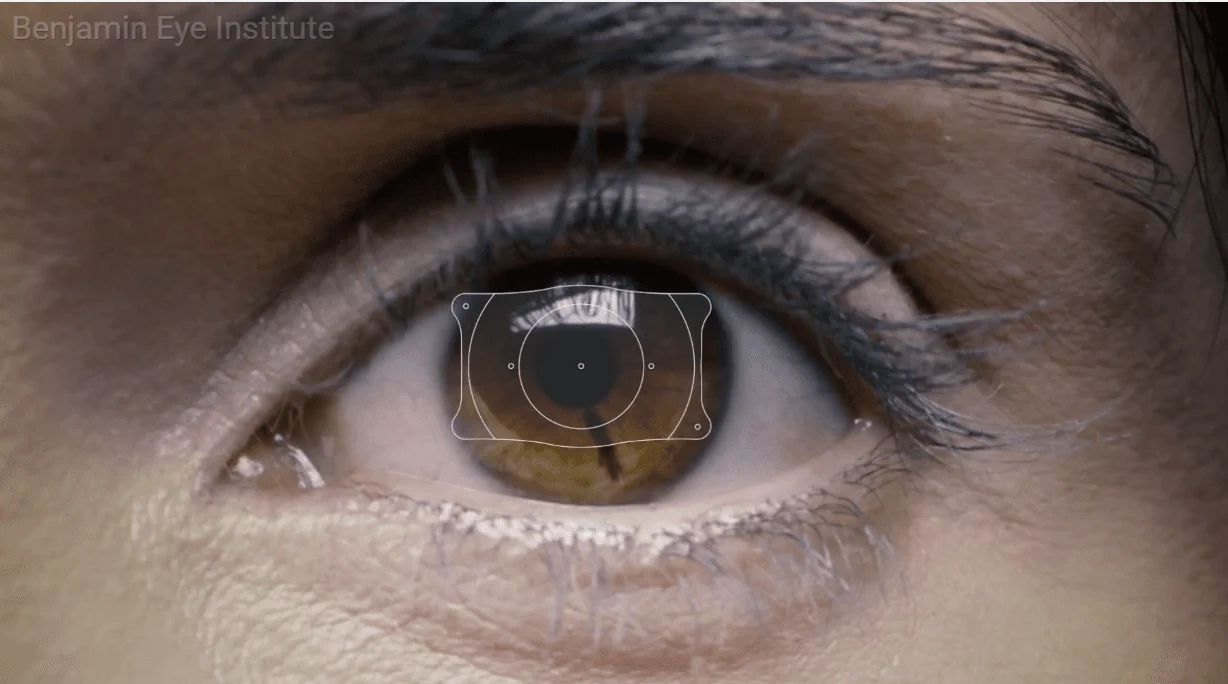 Beyond LASIK: The EVO ICL Difference