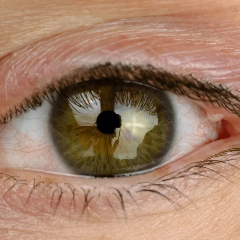 A Unique and Effective Treatment for Styes (Hordeola) at Benjamin Eye Institute