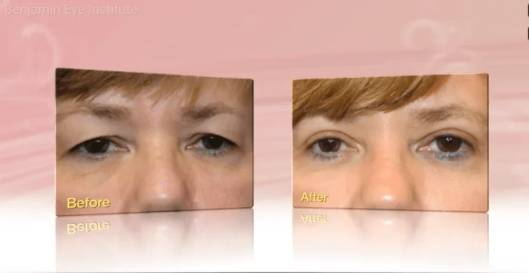 Blepharoplasty Explained: Eyelid Surgery by Dr. Arthur Benjamin in Los Angeles