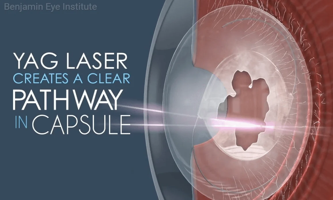 YAG Laser Capsulotomy: Clearer Vision After Cataract Surgery