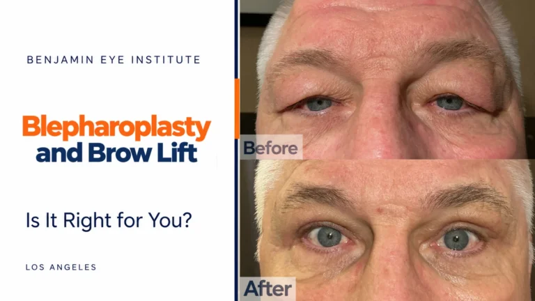 Blepharoplasty and Brow Lift in West Hollywood. Before and After