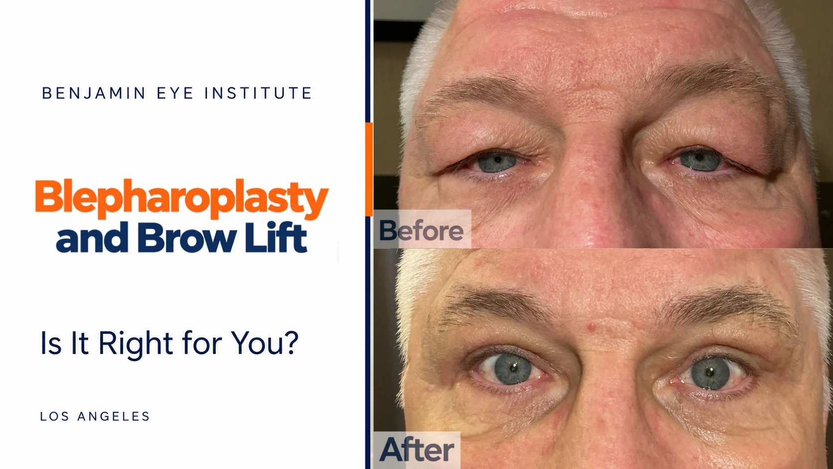 Blepharoplasty and Brow Lift in West Hollywood. Before and After