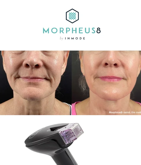 Maximize Your Results: Essential Aftercare for Tixel, Morpheus8, and IPL Treatments